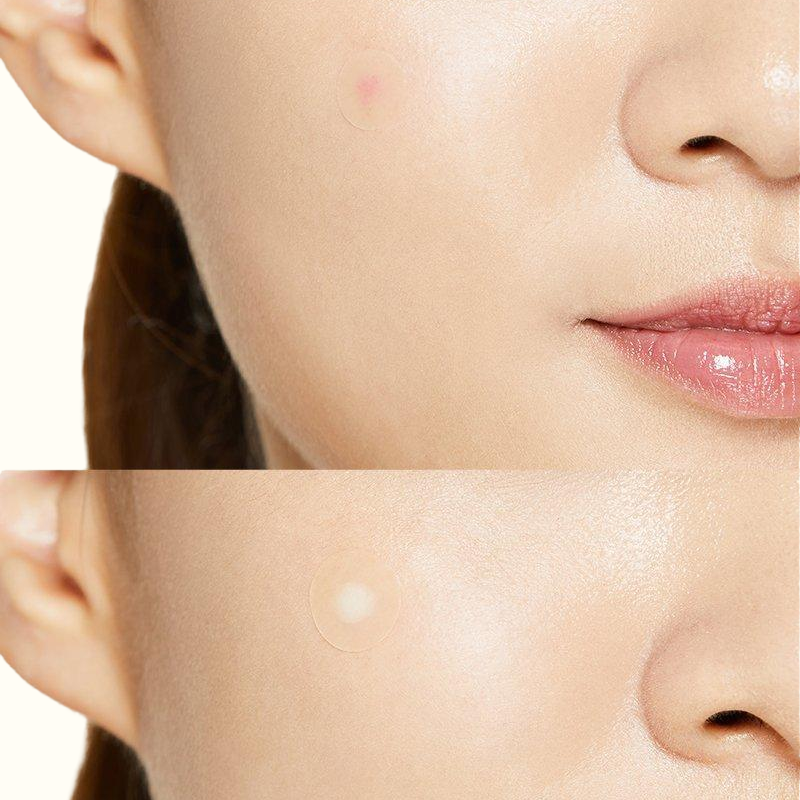 Acne Pimple Master Patch - Parches para acné y espinillas