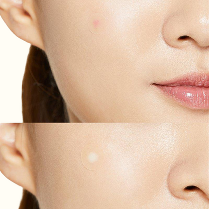 Acne Pimple Master Patch - Parches para acné y espinillas